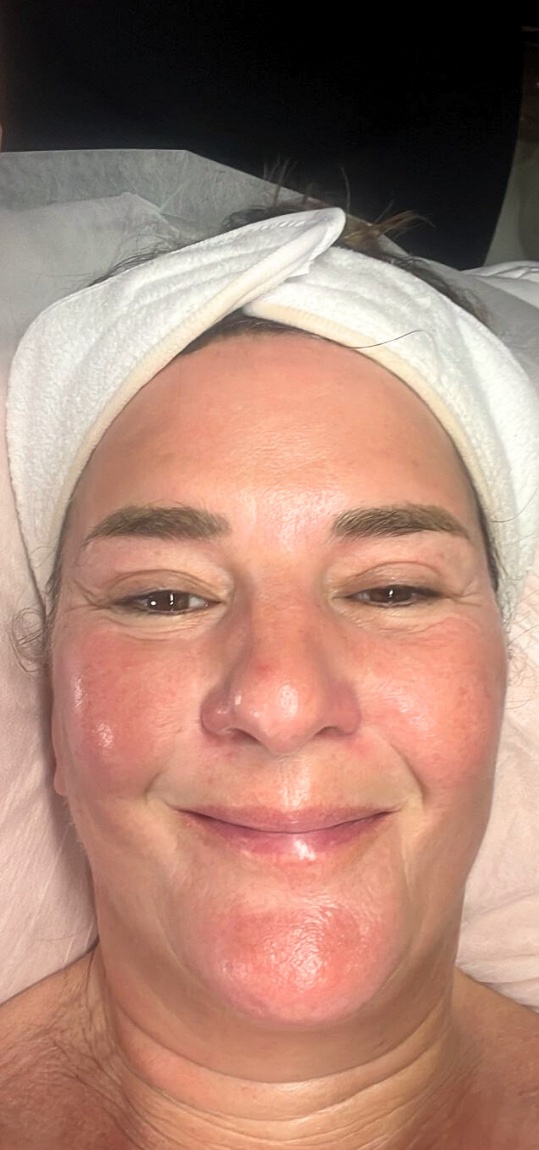 Day 21: the same participant after three weeks of face yoga